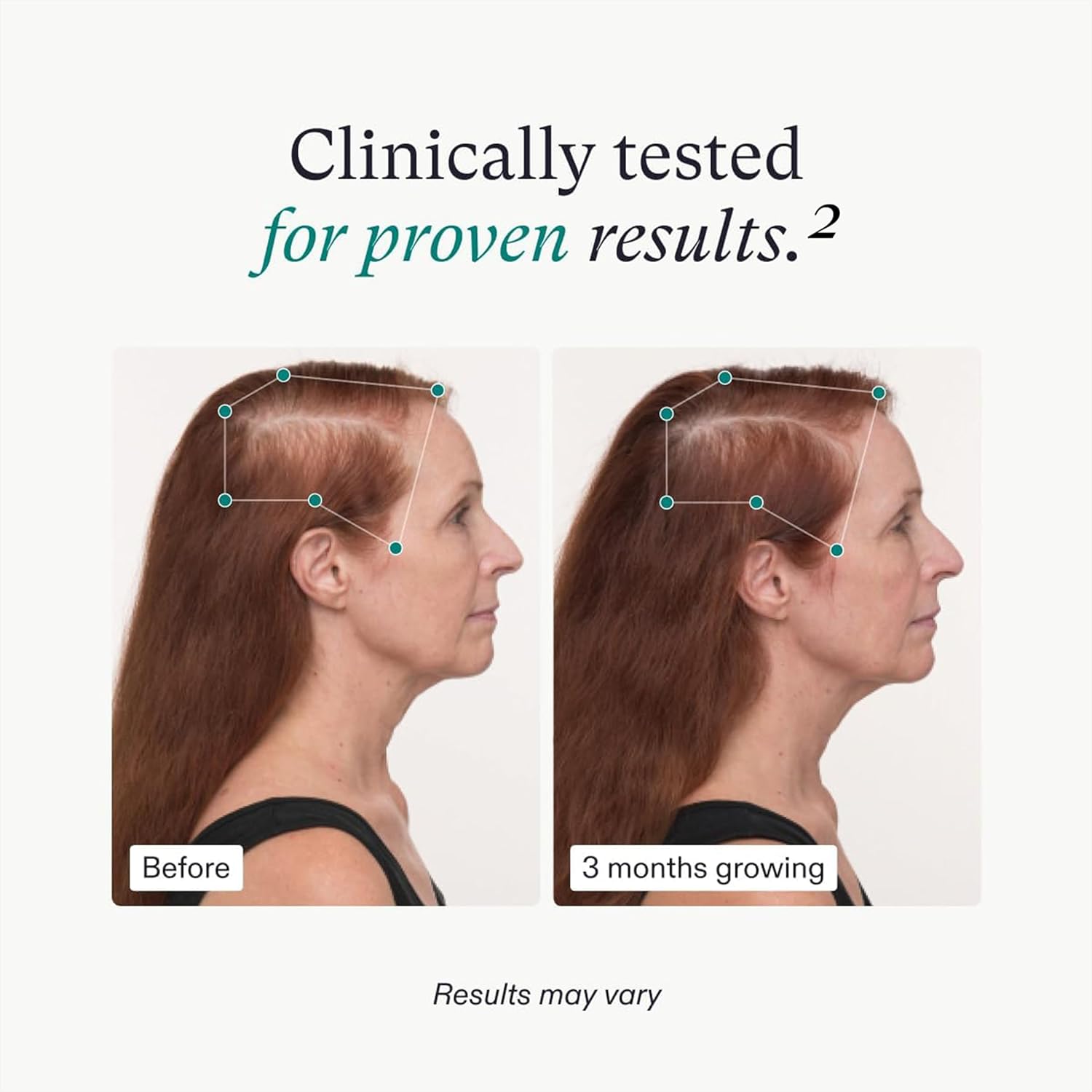 Nutrafol Women’s Balance – 1-month supply. For women 45+, supports thicker hair & scalp coverage. Clinically proven & dermatologist recommended