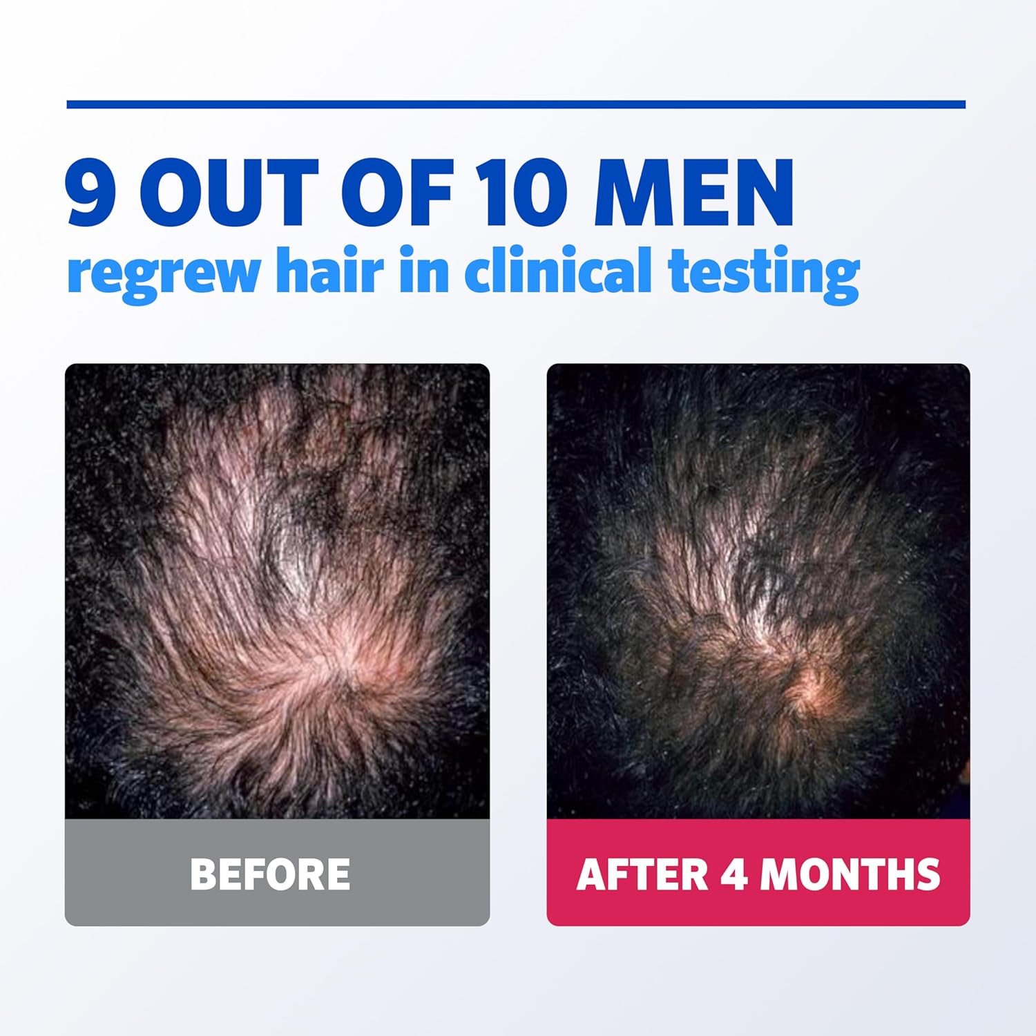 Men's Rogaine 5% Minoxidil Foam – 3 x 2.11 oz, 3-month supply. Unscented topical for hair regrowth, promotes fuller, thicker hair. Clinically proven